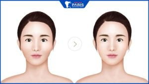 Phẩu thuật hạ gò má cao: Thay nhan sắc, đổi vận mệnh