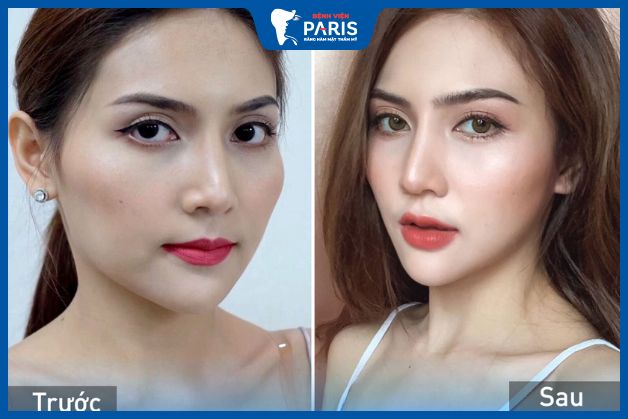 Hạ gò má cao giúp cải thiện tính thẩm mỹ