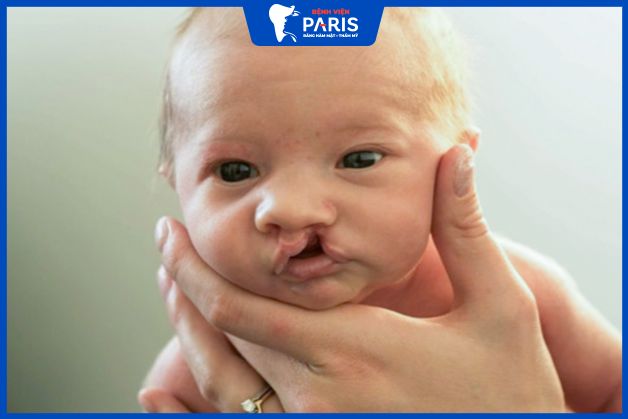 Nguyên nhân sứt môi và hở hàm ếch