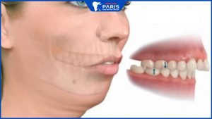 Phẫu thuật hàm hô ở đâu uy tín, tỉ lệ thành công lên đến 90%