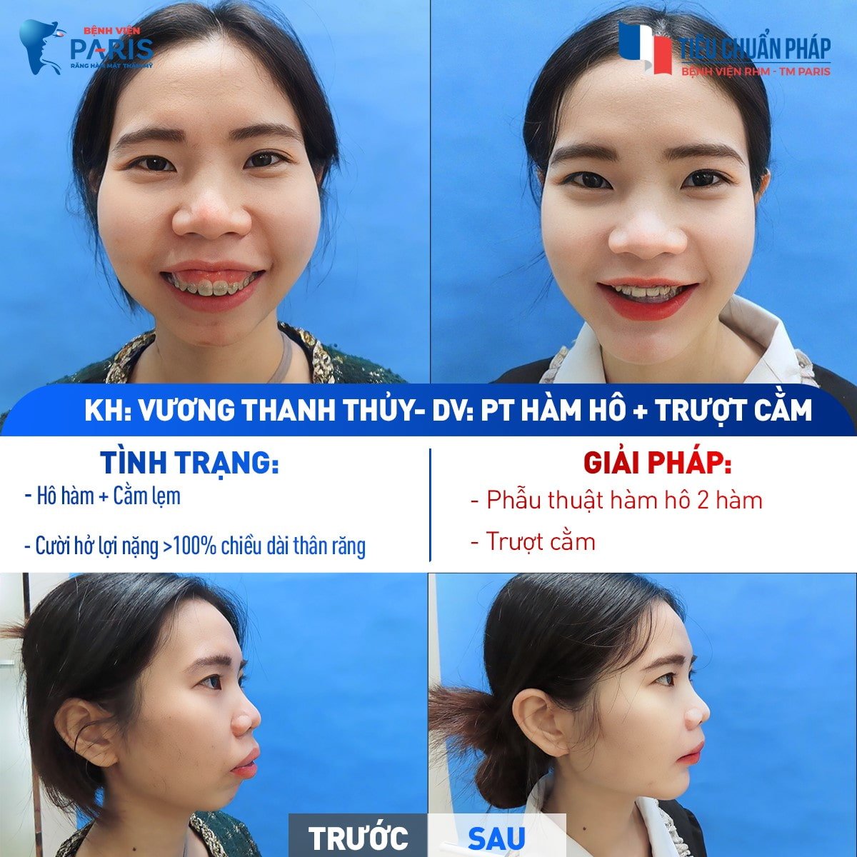 Hình ảnh khách hàng Thanh Thủy sau khi phẫu thuật hàm hô