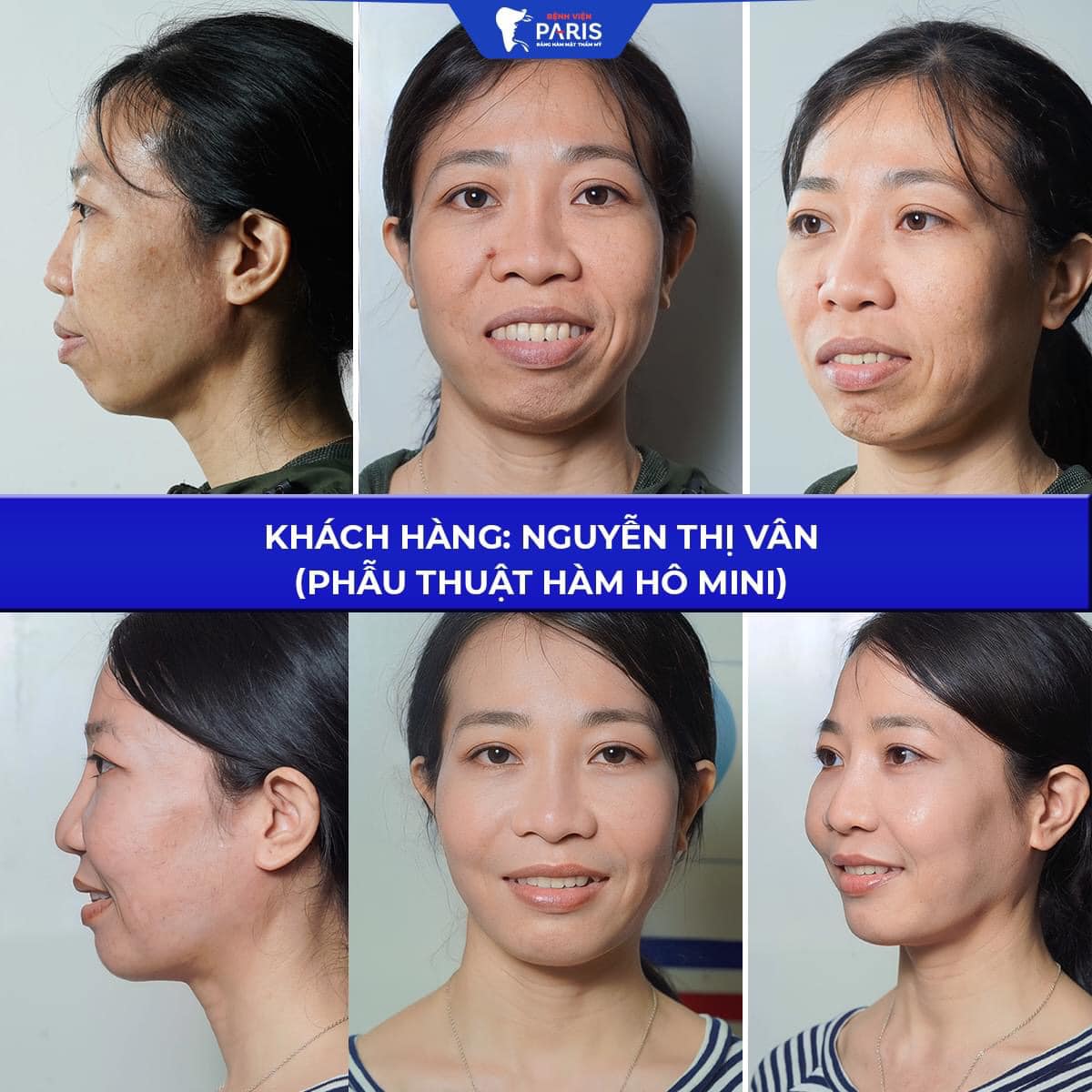 Khách hàng Trần Thị Vân thay đổi ngoạn mục sau phẫu thuật hàm hô