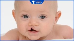 Sứt môi hở hàm ếch: Nguyên nhân, triệu chứng & cách điều trị