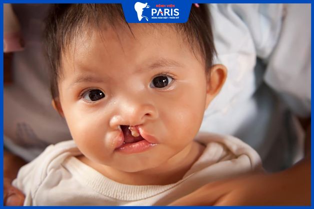 Triệu chứng khi bị sứt môi hở hàm ếch