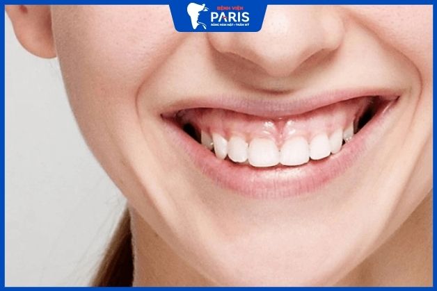 Tình trạng cười hở lợi