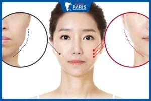 Địa chỉ gọt hàm uy tín – Bệnh Viện Răng Hàm Mặt Thẩm Mỹ Paris