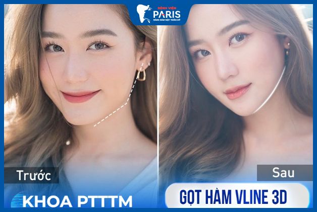 Khách hàng Bảo Vy xinh đẹp hơn sau gọt hàm
