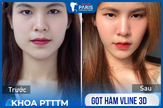 Khách hàng Mỹ Thanh lột xác sau phẫu thuật