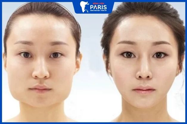 gọt hàm có nguy hiểm không