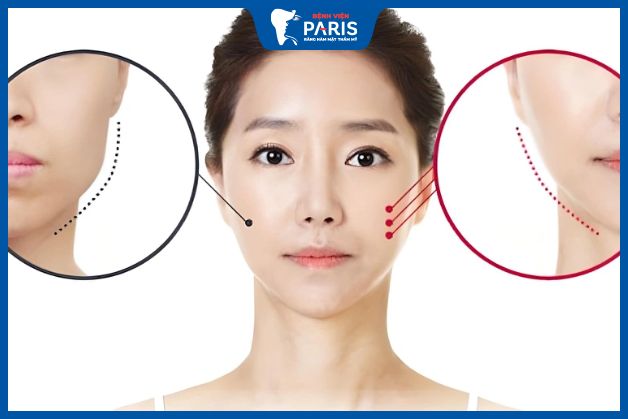 Gọt hàm có đau không