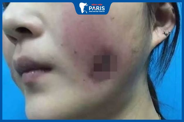 Biến chứng nhiễm trùng sau khi gọt hàm