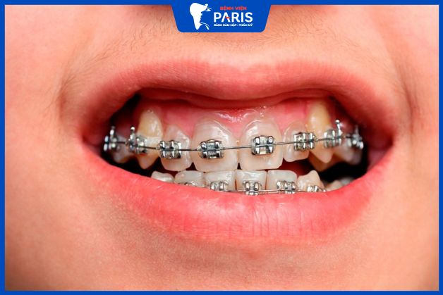 Niềng răng chữa cười hở lợi
