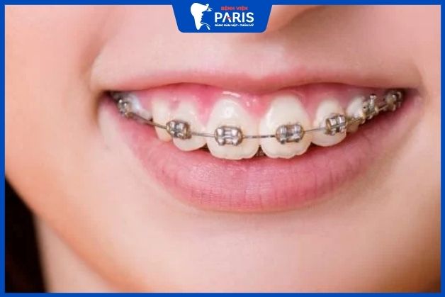 Niềng răng khắc phục hở lợi