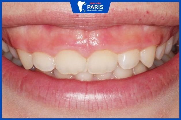 Phẫu thuật cười hở lợi
